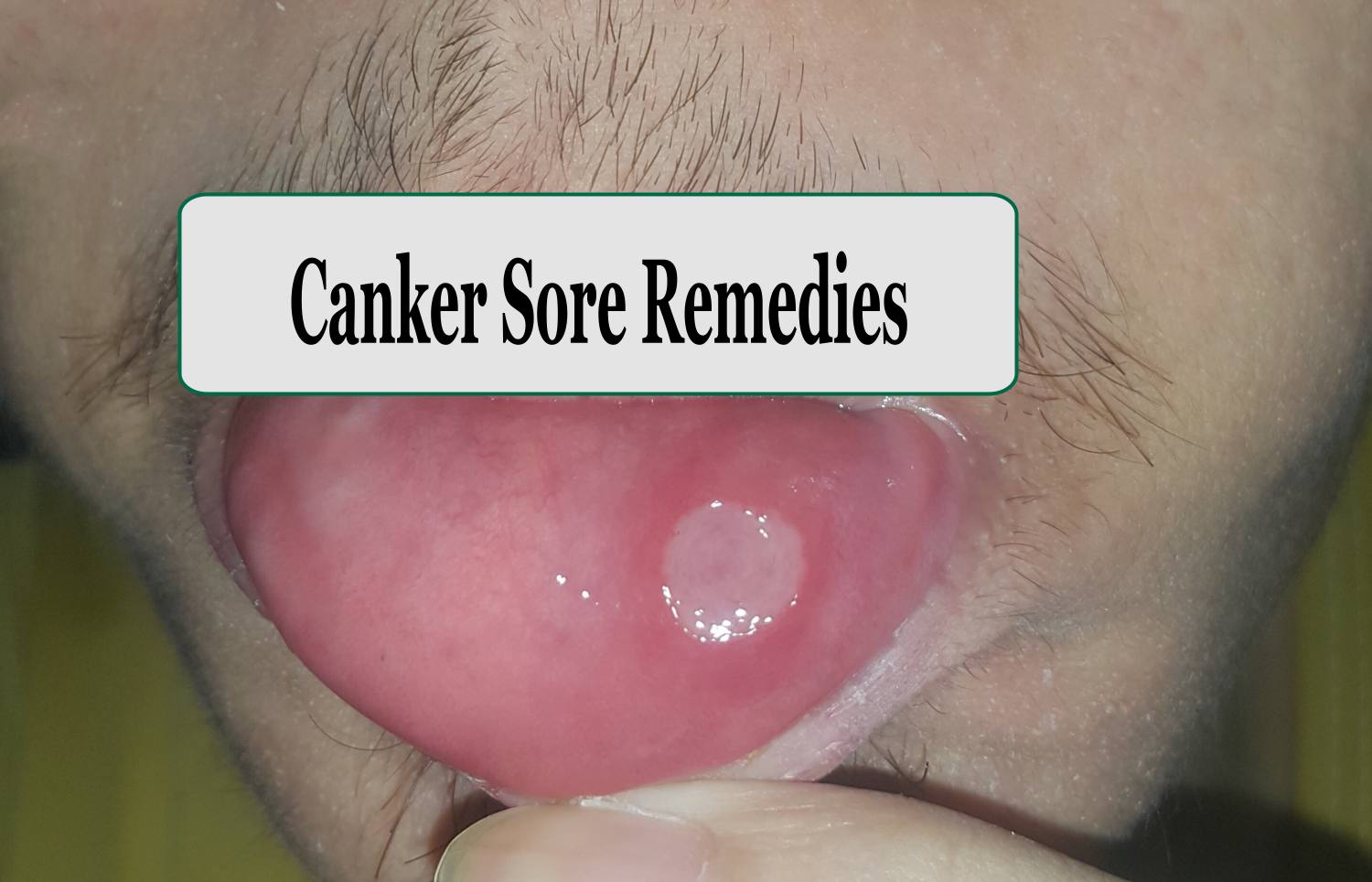 10 Home Remedies for canker sores