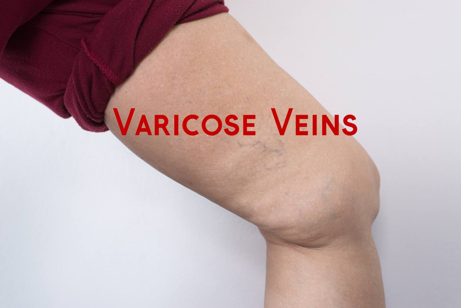 !0 Home Remedies for Varicose Veins