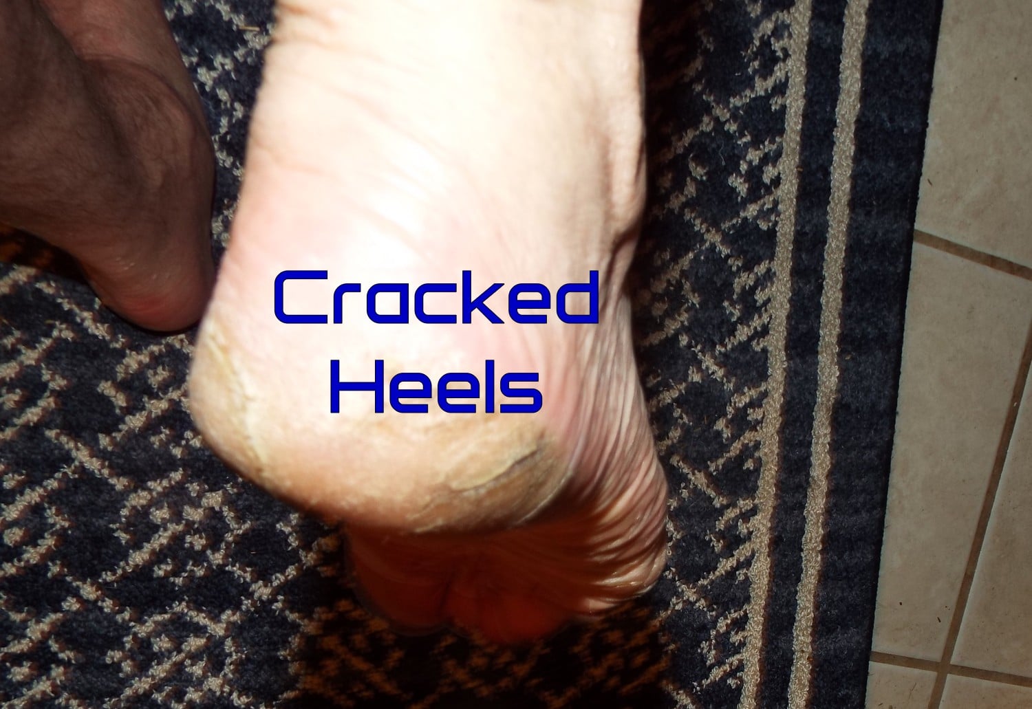 10 Home Remedies for Cracked Heels