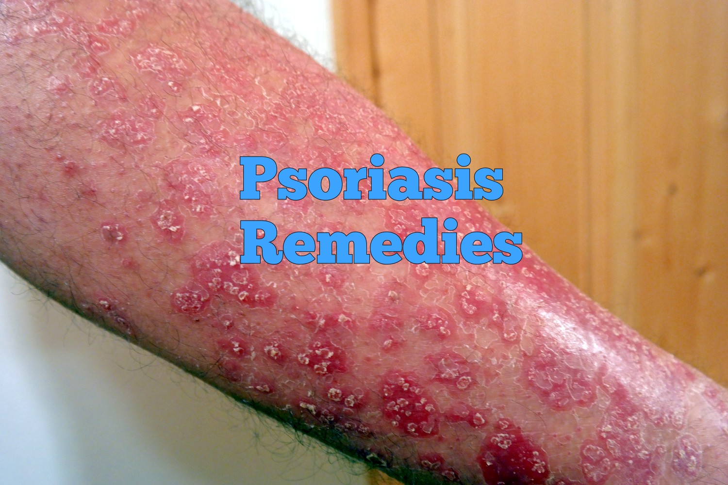 10 Home Remedies for Psoriasis