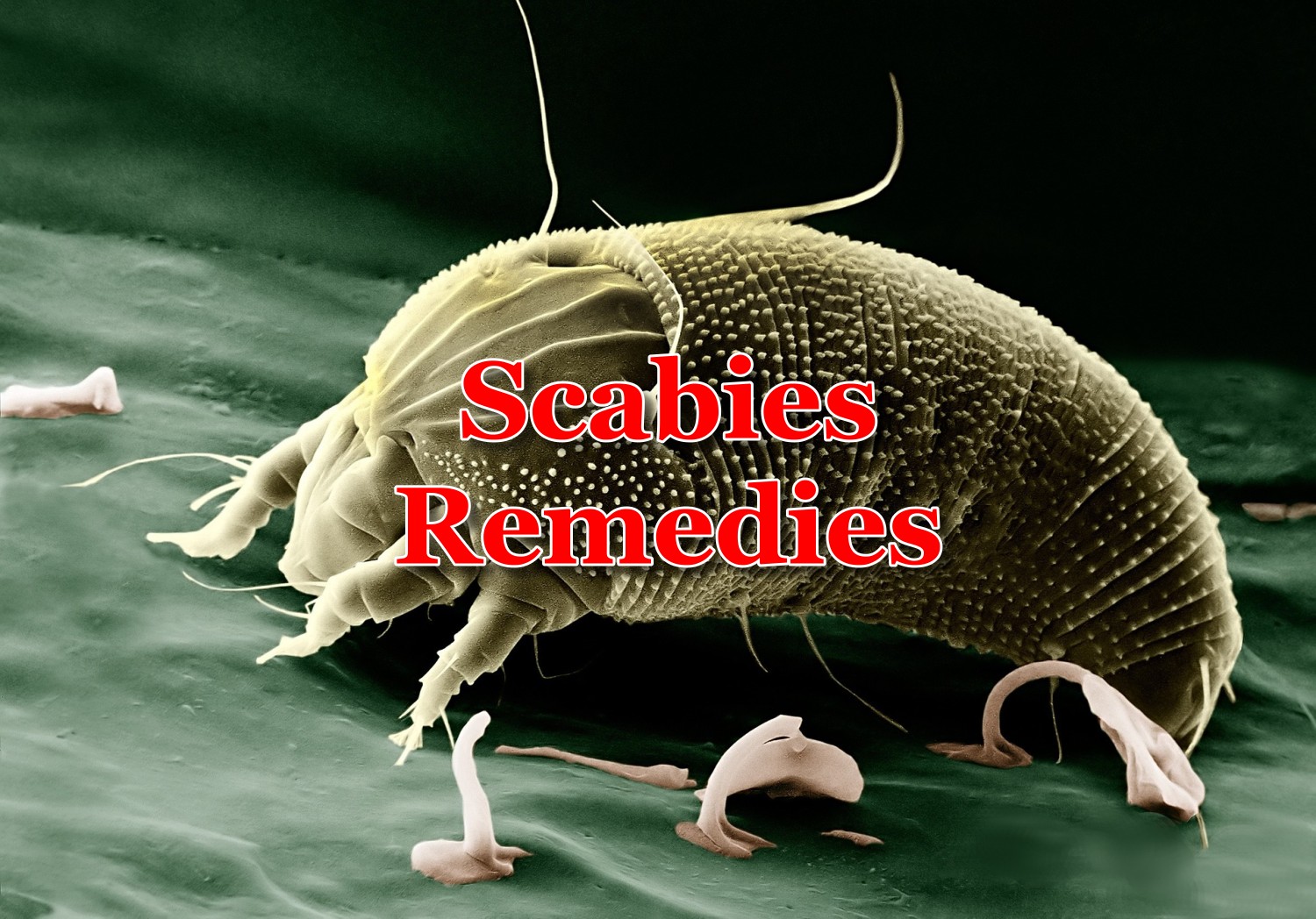 10 Home Remedies for Scabies