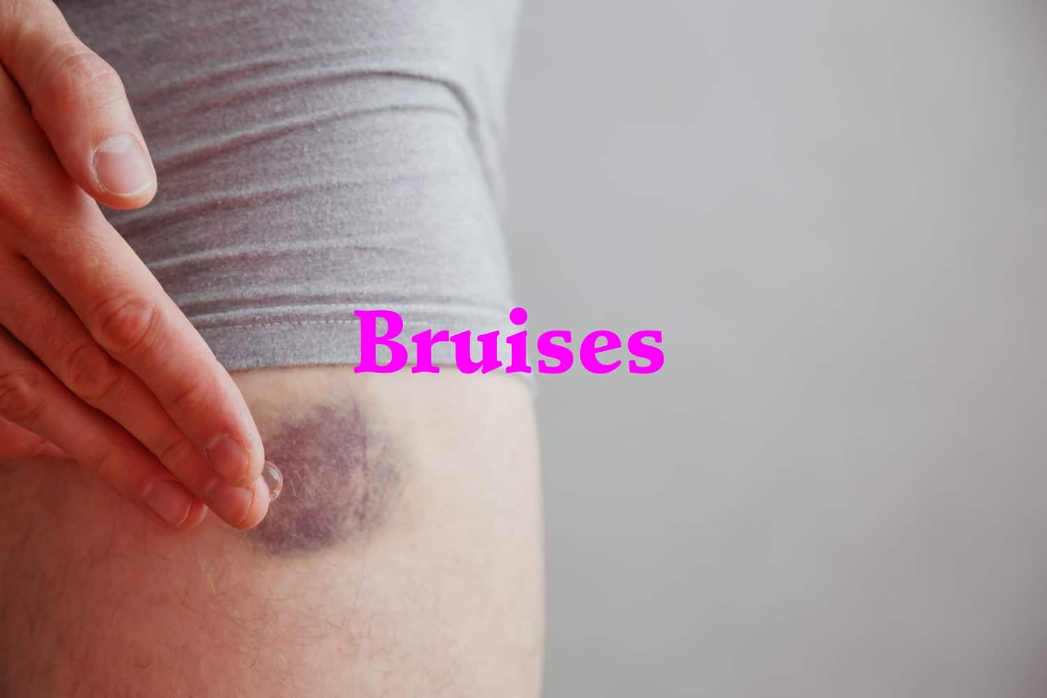 10 Home Remedies for Bruising